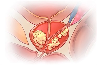 Рак предстательной железы у мужчины 64 лет